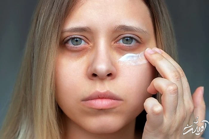 متورم شدن چشم